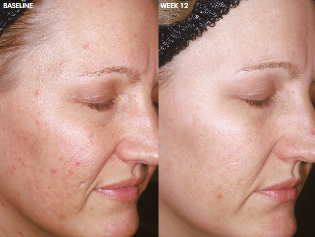 aczone-acne-treatment-yoderm